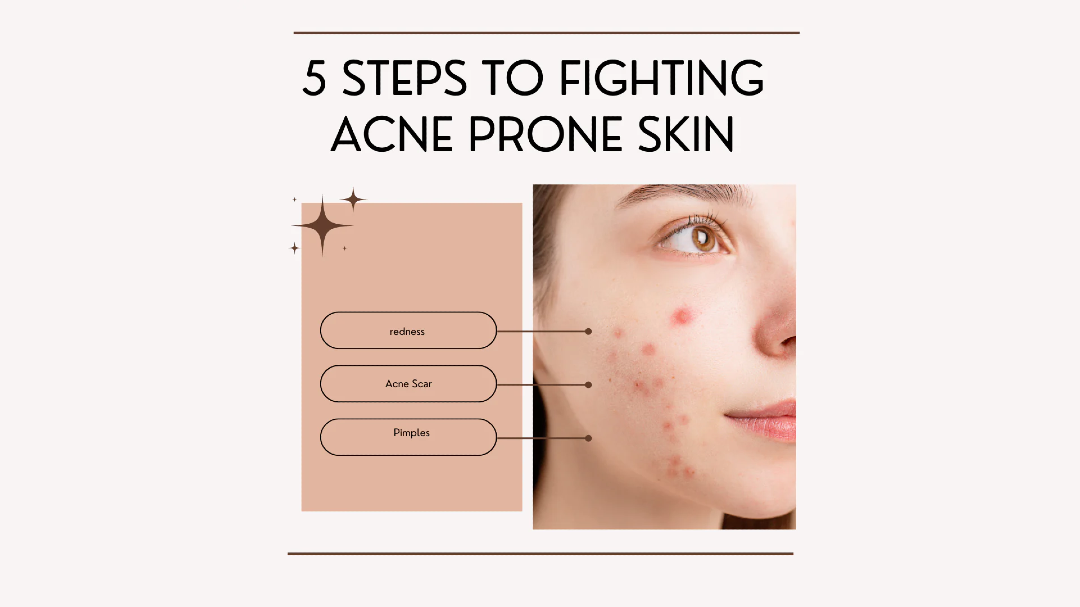 How To Treat Your Acne Skin Right In 5 Steps